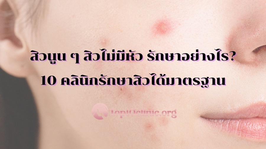 สิวนูน ๆ สิวไม่มีหัว รักษาอย่างไร? 10 คลินิกรักษาสิวได้มาตรฐาน